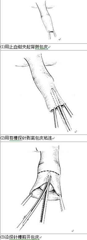 割下来的包皮可以吃吗